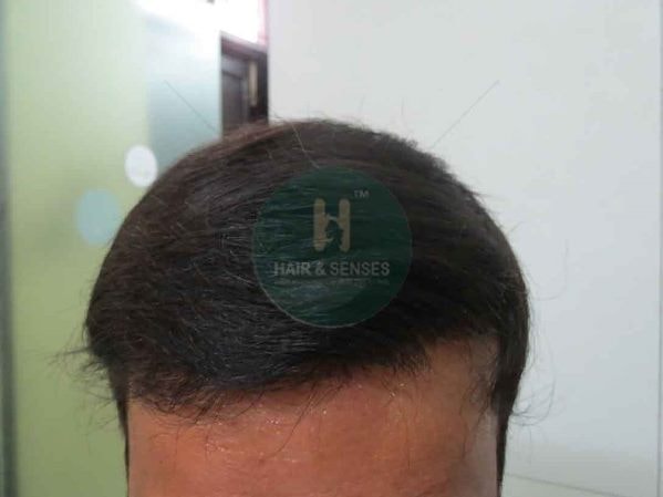 Hair Transplant Case Study